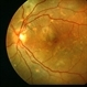 Central Serous Chorioretinopathy 4